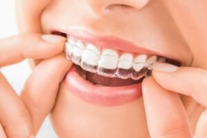 benefits of invisible braces clear aligners South Kolkata