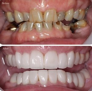 dental implants case
