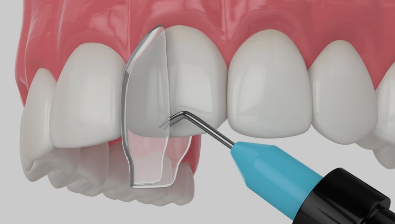 Composite Bonding at City Smiles Dental Care