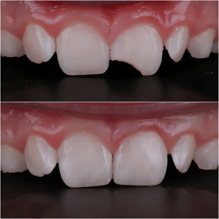 Dental Bonding Issues treated through cosmetic dentistry at City Smiles Dental Care