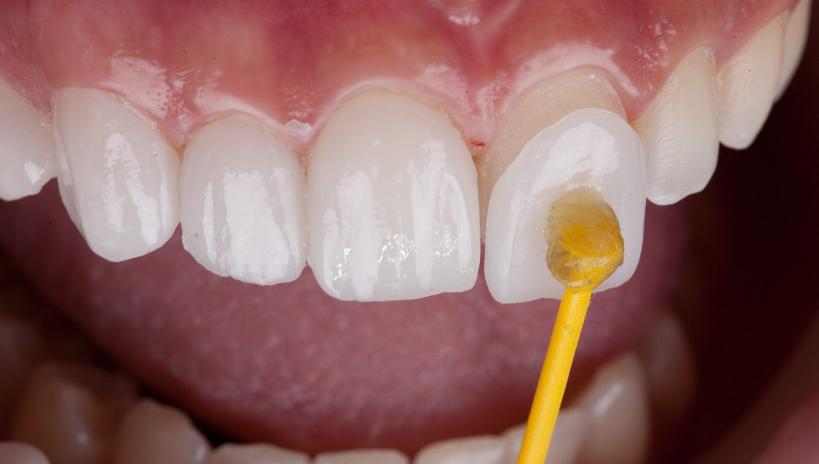 Dental Veneers at City Smiles Dental Care