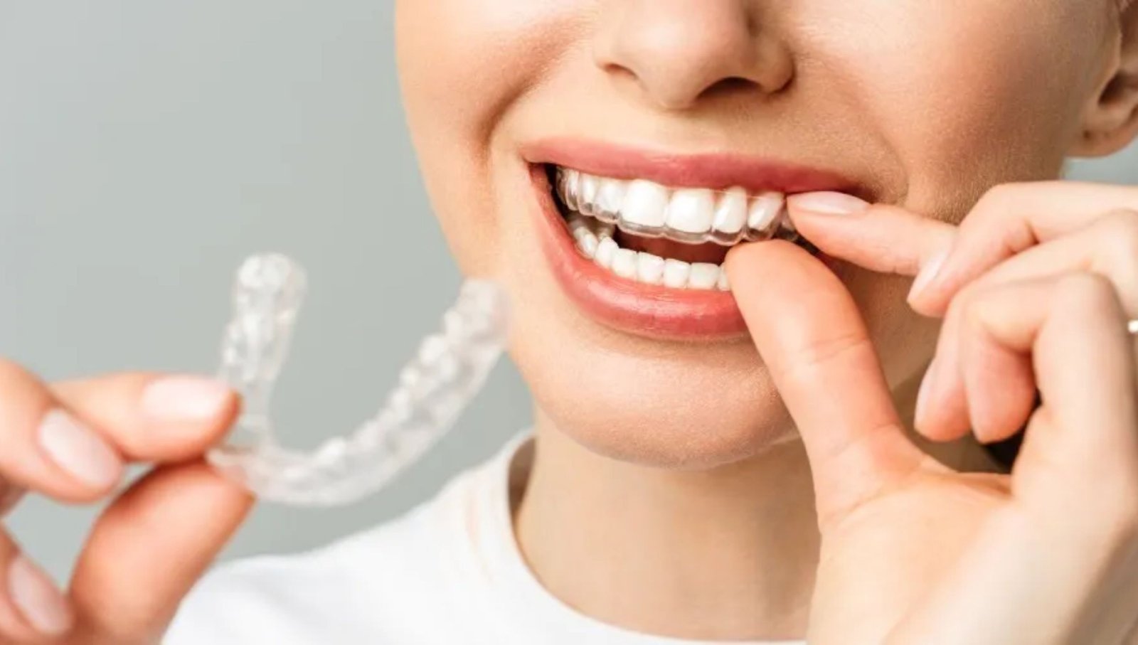 Invisible Braces at City Smiles Dental Care