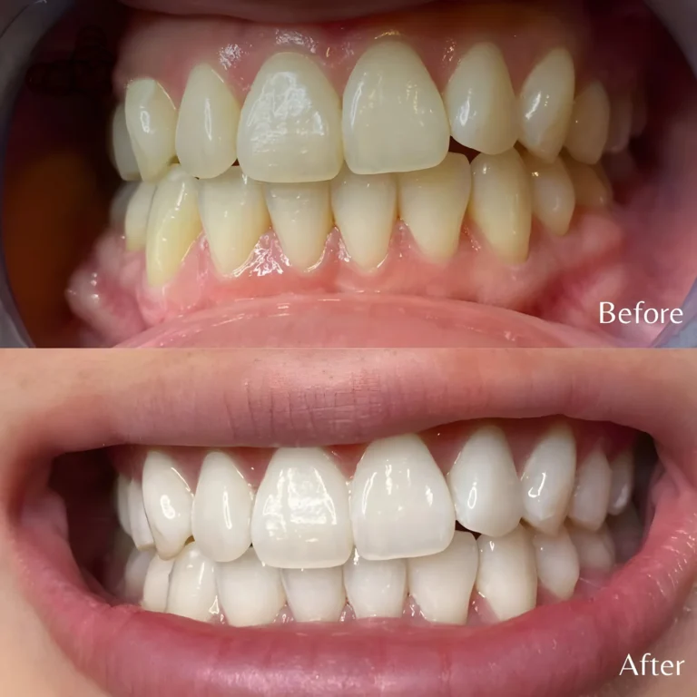 Teeth Whitening Issues treated through cosmetic dentistry at City Smiles Dental Care