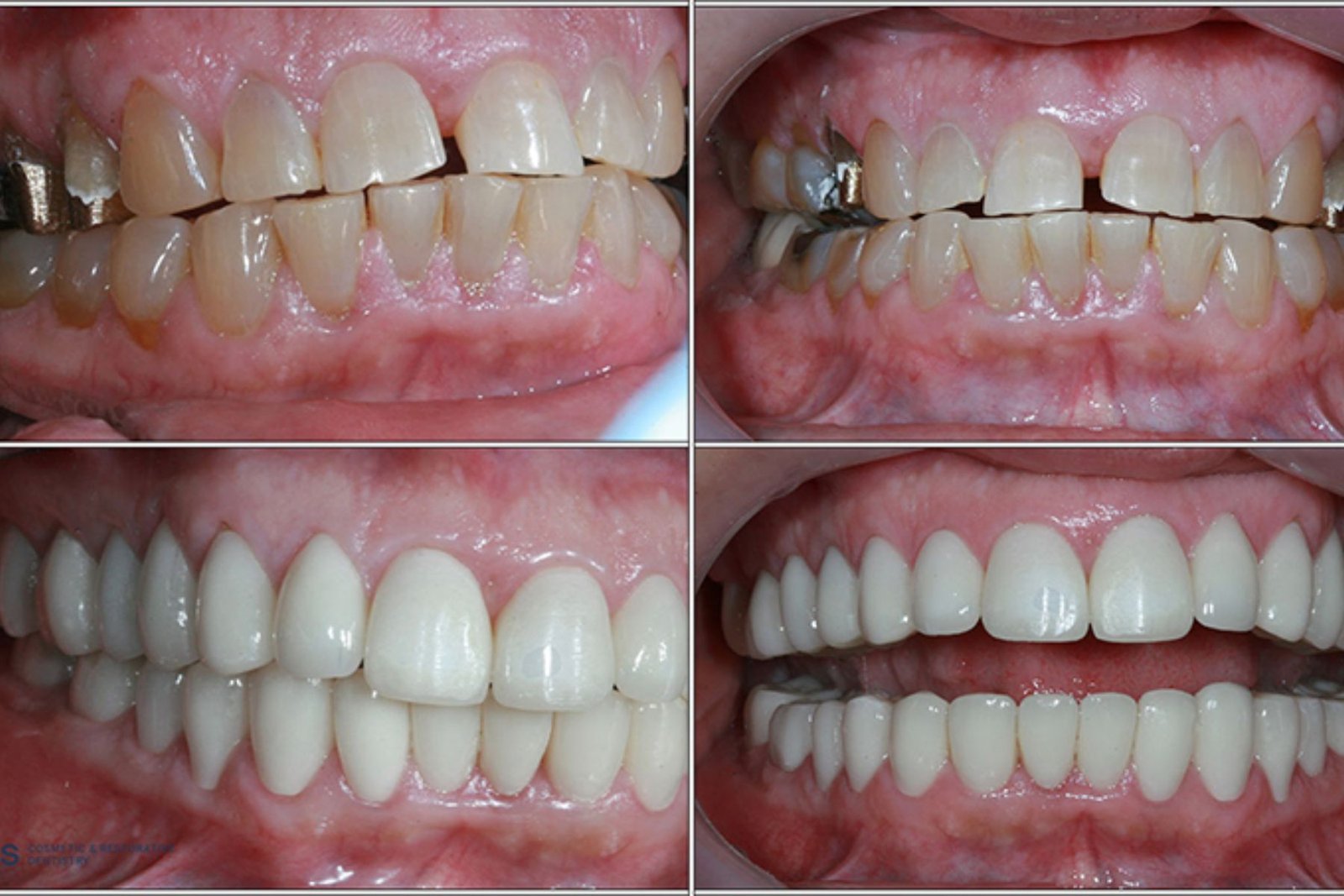 Dentures & Full-Mouth Rehabilitation in South Kolkata