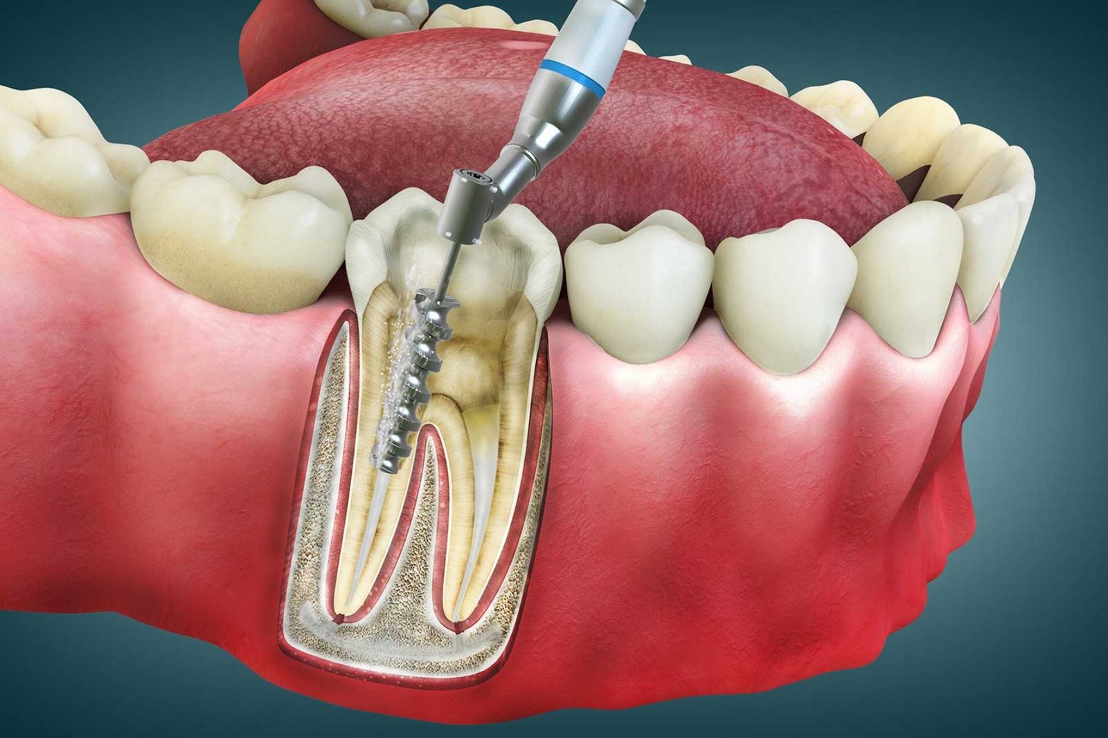Root Canal Treatment in South Kolkata
