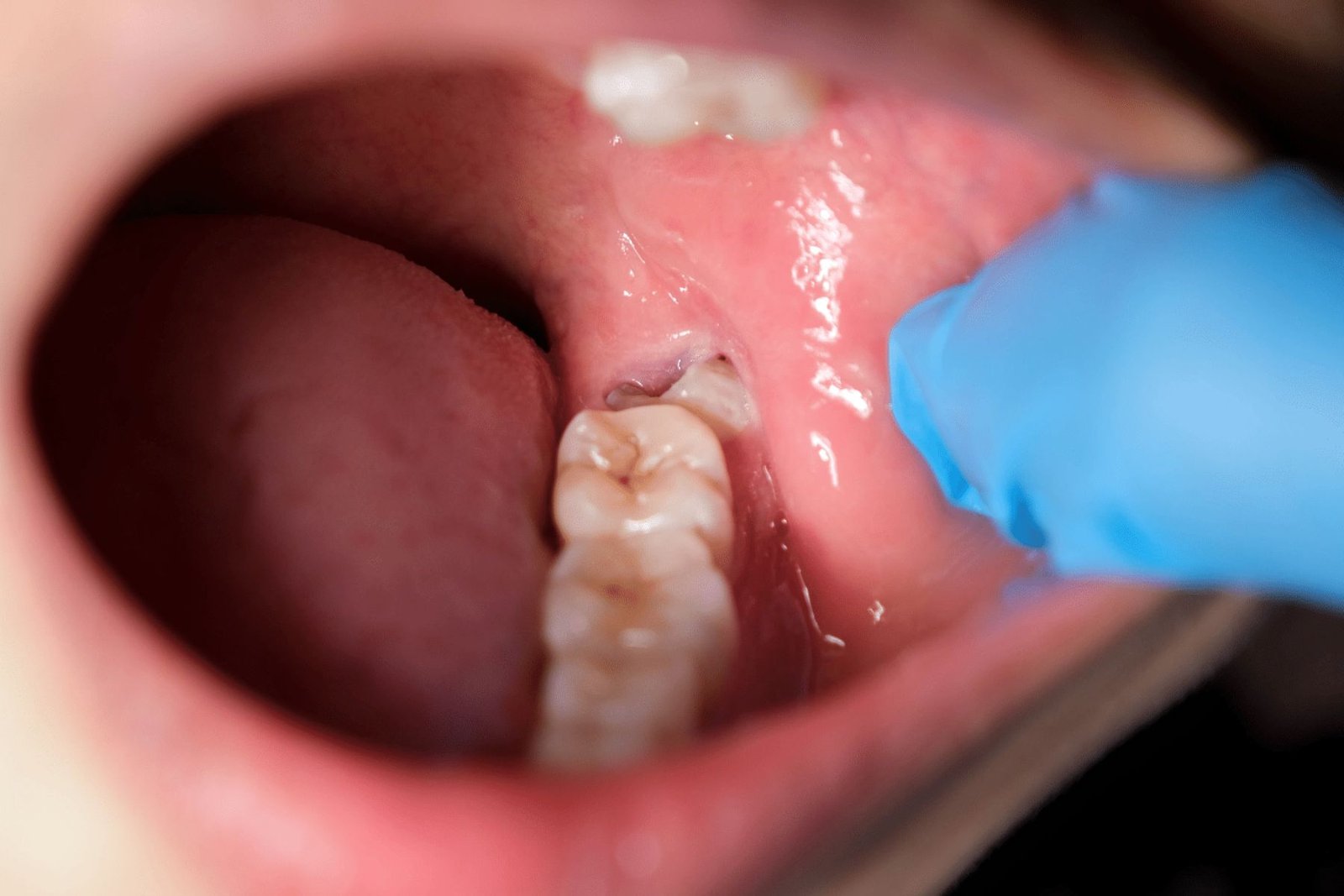 Wisdom Tooth Extraction in South Kolkata