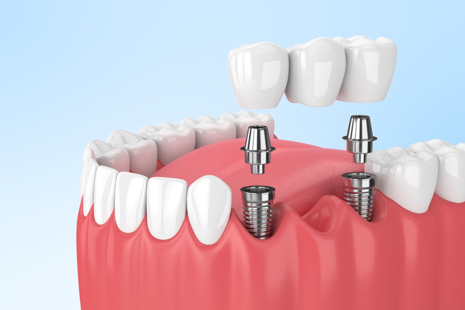 Dental Implants in South Kolkata