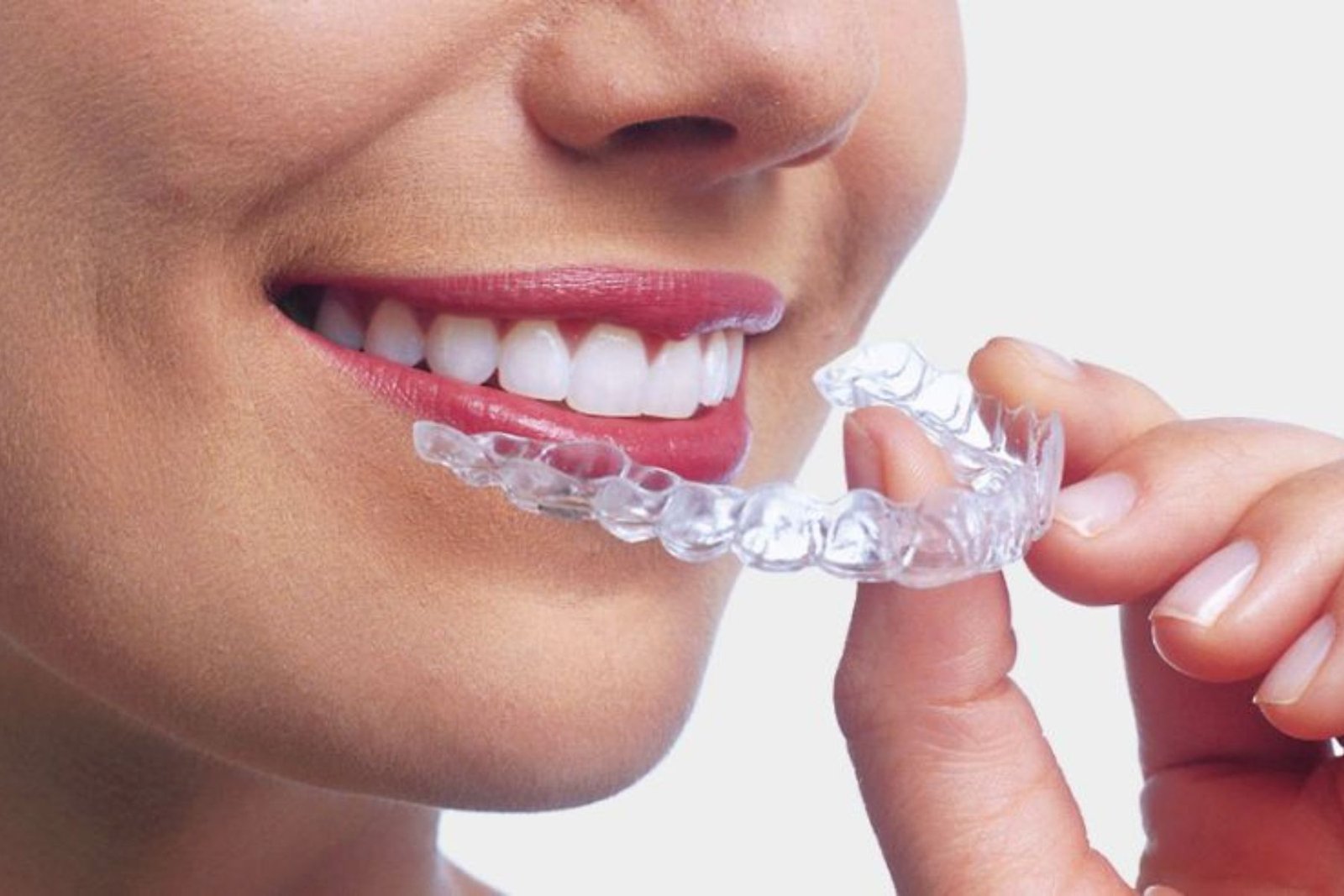 Invisible Braces in South Kolkata
