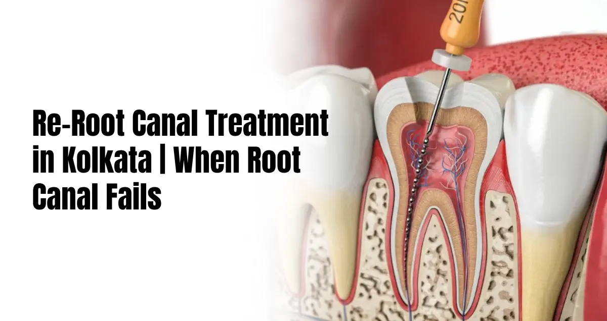 Re-Root Canal Treatment