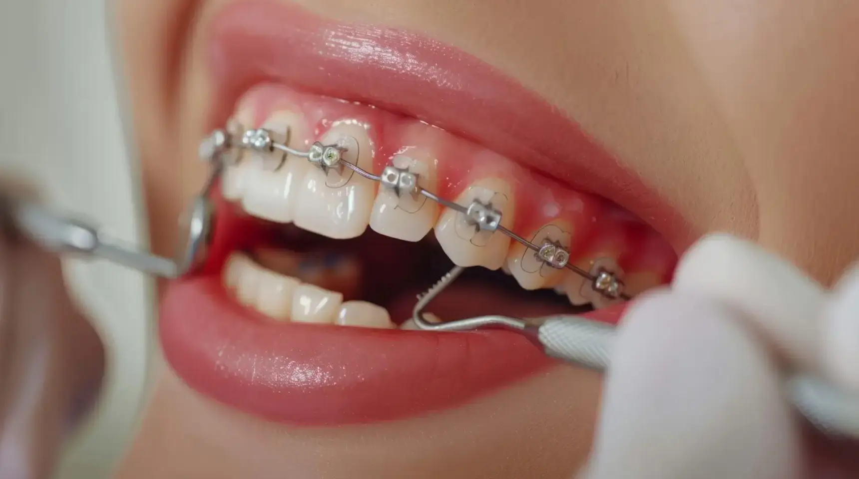 Braces & Orthodontic Treatment