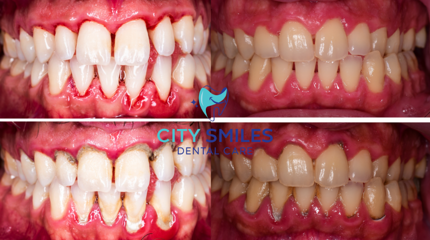 Gum Treatment & Periodontal Care