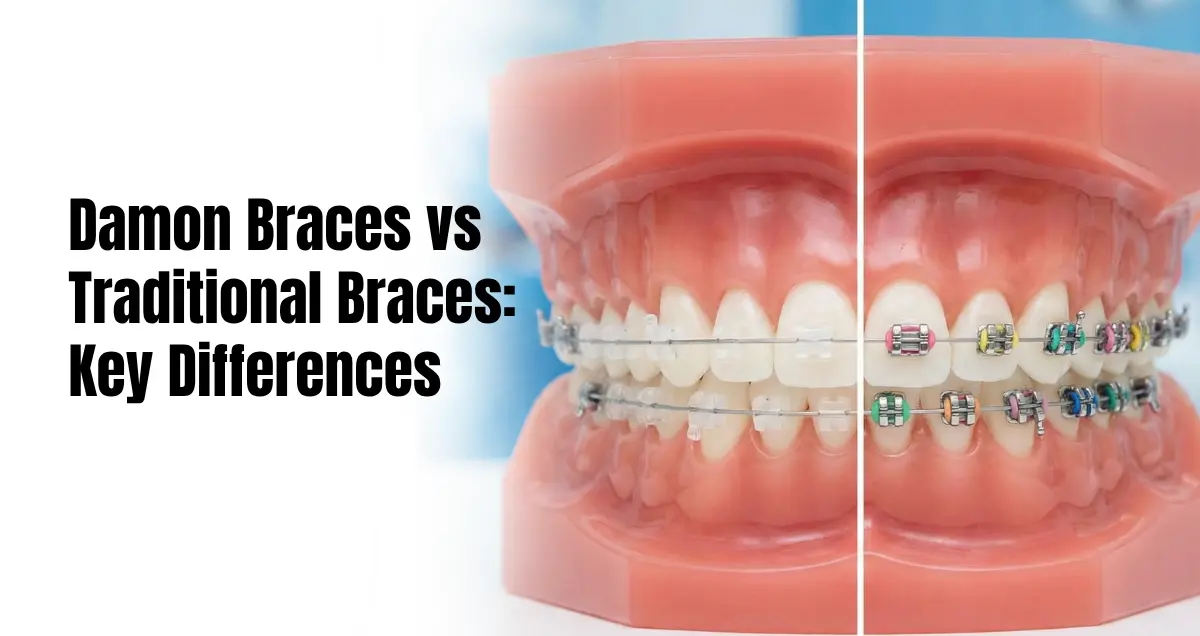 Damon Braces vs Traditional Braces