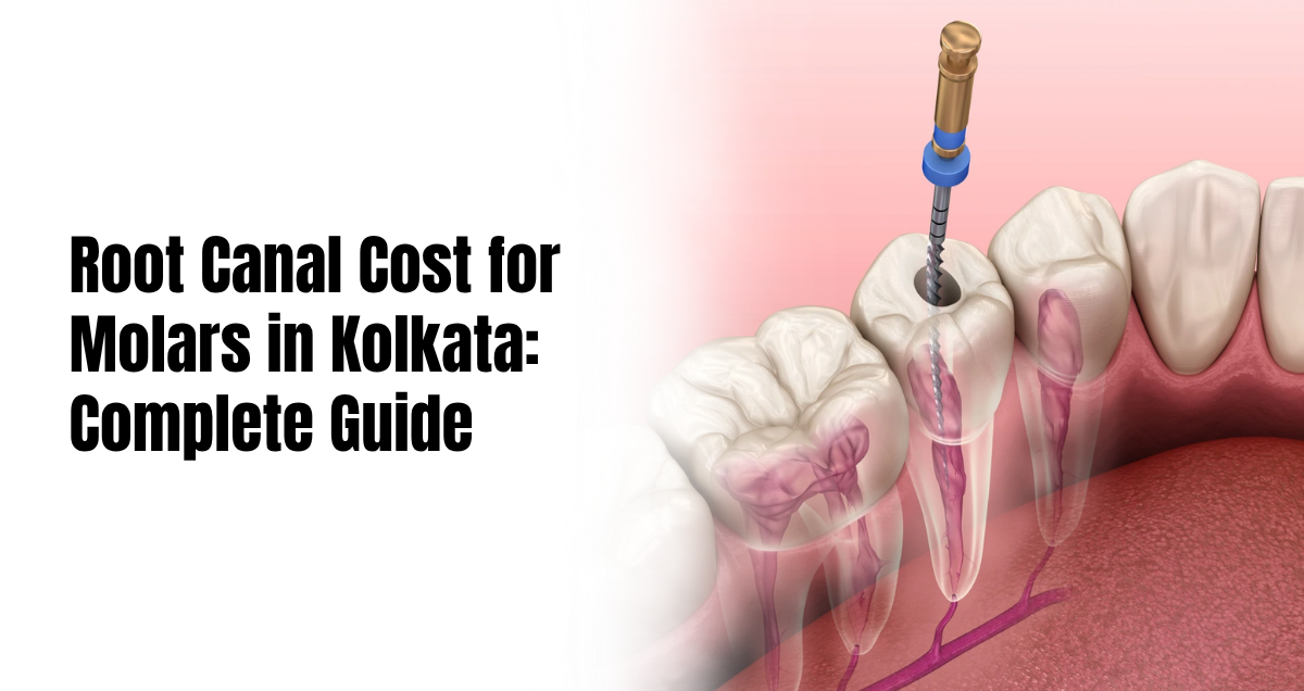 Root canal cost for molars