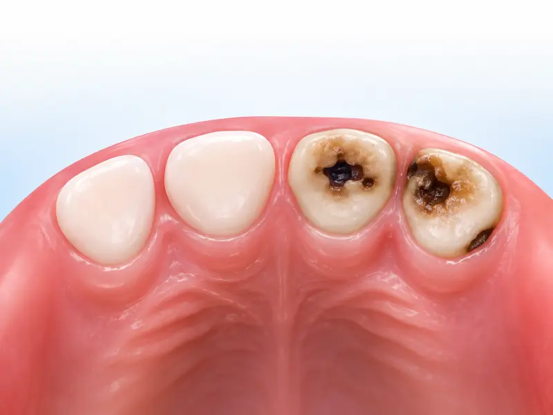 Illustration showing child tooth decay and cavities in milk teeth — common in children from South Kolkata